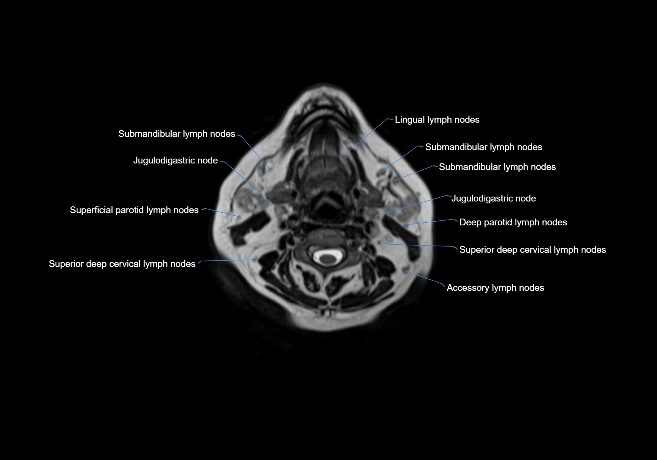 Neck axial  lymph node cross sectional MRI anatomy 3T MRI  image-img-00001-00050.webp